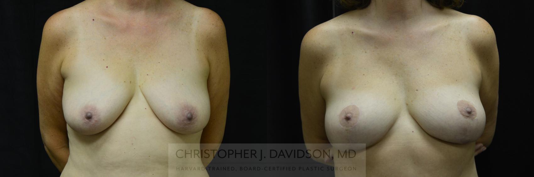 Breast Lift Case 214 Before & After View #1 | Wellesley, MA | Christopher J. Davidson, MD