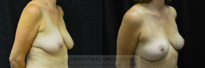 Breast Lift Case 214 Before & After View #2 | Boston, MA | Christopher J. Davidson, MD