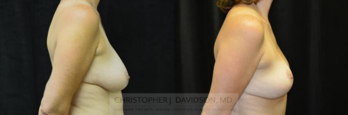 Breast Lift Case 214 Before & After View #3 | Boston, MA | Christopher J. Davidson, MD