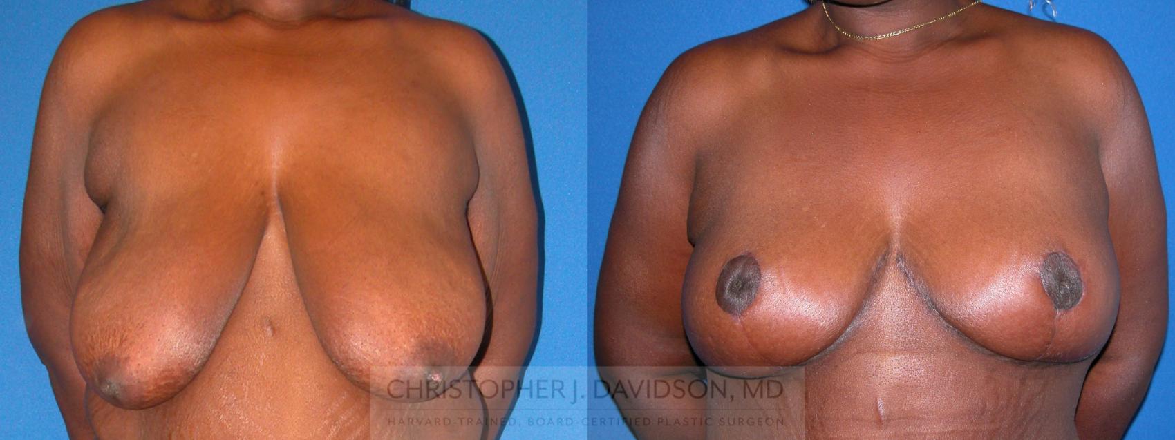 Breast Lift Case 217 Before & After View #1 | Wellesley, MA | Christopher J. Davidson, MD