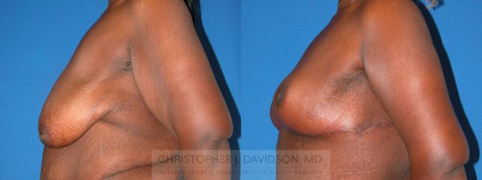 Breast Lift Case 217 Before & After View #2 | Boston, MA | Christopher J. Davidson, MD