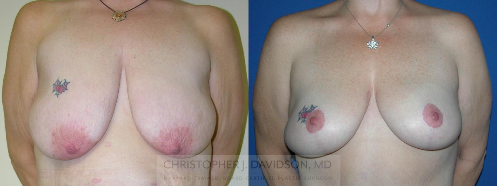 Breast Lift Case 226 Before & After View #1 | Wellesley, MA | Christopher J. Davidson, MD