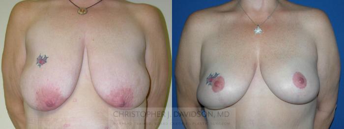 Breast Lift Case 226 Before & After View #1 | Boston, MA | Christopher J. Davidson, MD