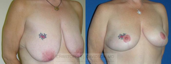 Breast Lift Case 226 Before & After View #2 | Boston, MA | Christopher J. Davidson, MD