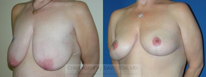 Breast Lift Case 226 Before & After View #3 | Boston, MA | Christopher J. Davidson, MD