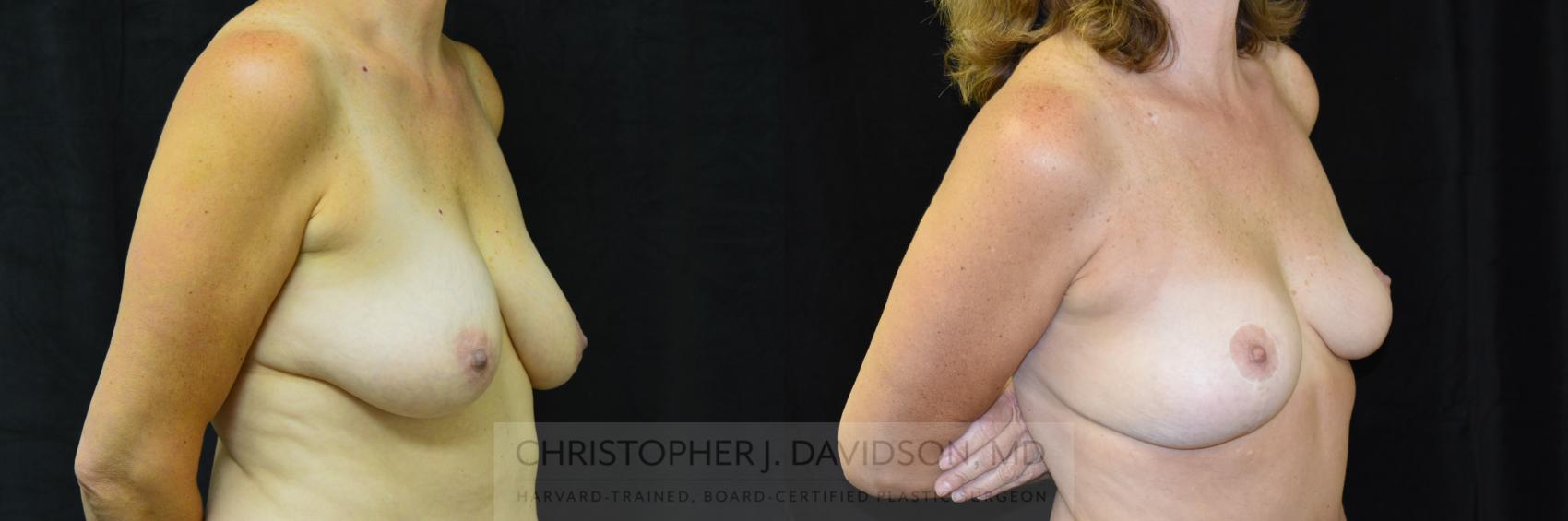 Breast Lift Case 246 Before & After View #1 | Wellesley, MA | Christopher J. Davidson, MD