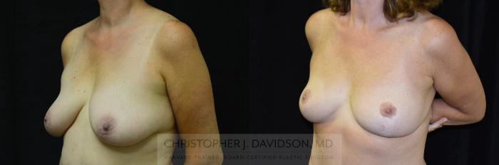 Breast Lift Case 246 Before & After View #3 | Boston, MA | Christopher J. Davidson, MD