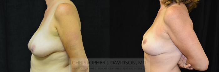 Breast Lift Case 246 Before & After View #4 | Boston, MA | Christopher J. Davidson, MD