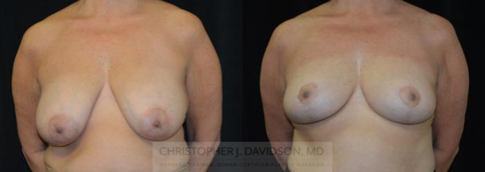 Breast Lift Case 319 Before & After Front | Boston, MA | Christopher J. Davidson, MD