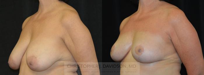 Breast Lift Case 319 Before & After Left Oblique | Boston, MA | Christopher J. Davidson, MD