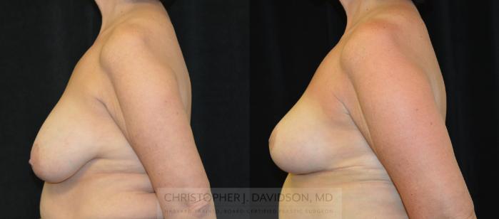 Breast Lift Case 319 Before & After Left Side | Boston, MA | Christopher J. Davidson, MD