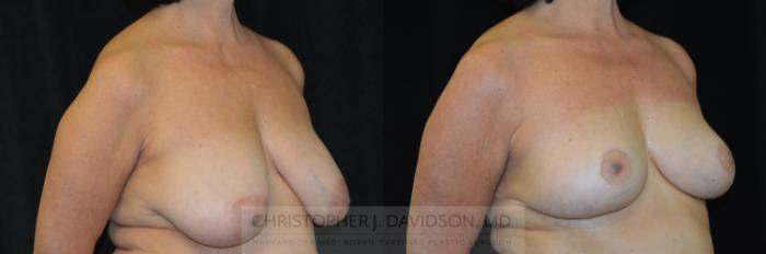 Breast Lift Case 319 Before & After Right Oblique | Boston, MA | Christopher J. Davidson, MD