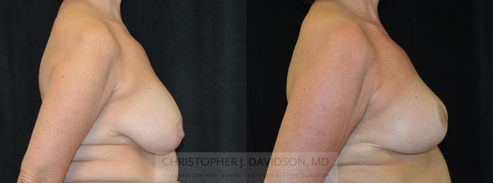 Breast Lift Case 319 Before & After Right Side | Boston, MA | Christopher J. Davidson, MD
