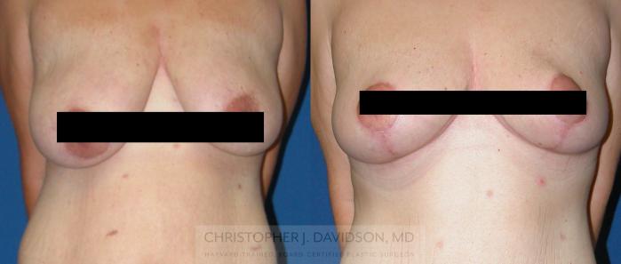 Breast Lift Case 335 Before & After Front | Boston, MA | Christopher J. Davidson, MD