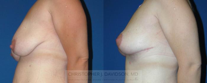 Breast Lift Case 335 Before & After Left Side | Boston, MA | Christopher J. Davidson, MD