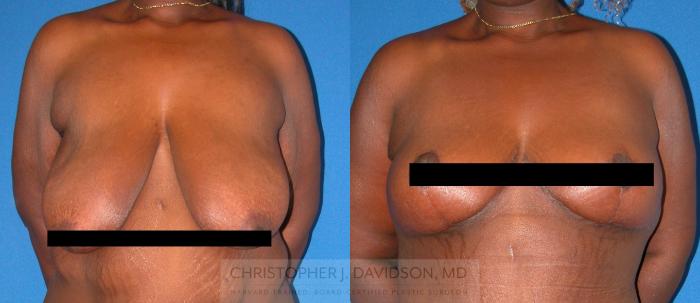 Breast Lift Case 336 Before & After Front | Boston, MA | Christopher J. Davidson, MD