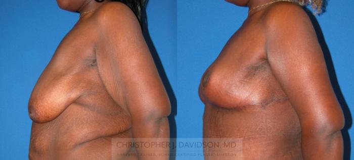 Breast Lift Case 336 Before & After Left Side | Boston, MA | Christopher J. Davidson, MD