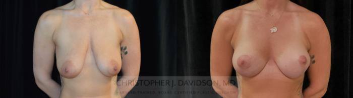 Breast Lift Case 369 Before & After Front | Boston, MA | Christopher J. Davidson, MD