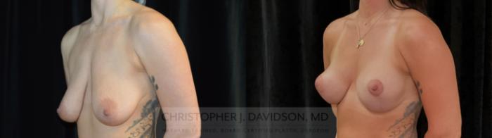 Breast Lift Case 369 Before & After Left Oblique | Boston, MA | Christopher J. Davidson, MD