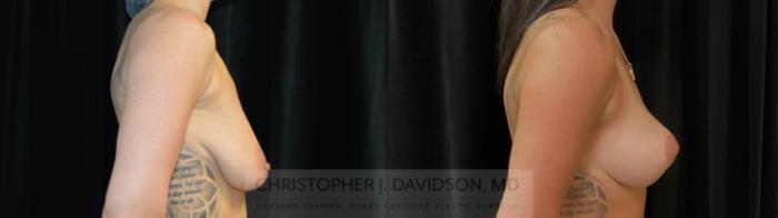 Breast Lift Case 369 Before & After Right Side | Boston, MA | Christopher J. Davidson, MD