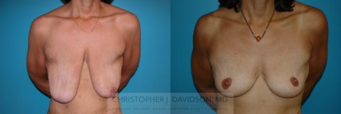 Breast Lift Case 397 Before & After Front | Boston, MA | Christopher J. Davidson, MD