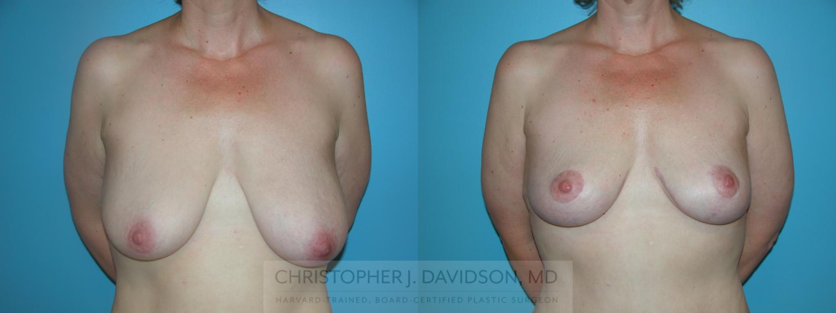 Breast Lift Case 400 Before & After Front | Boston, MA | Christopher J. Davidson, MD