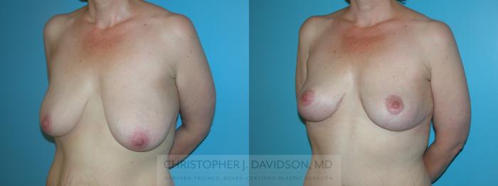 Breast Lift Case 400 Before & After Left Oblique | Boston, MA | Christopher J. Davidson, MD