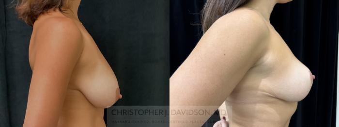 Breast Lift Case 428 Before & After Right Side | Boston, MA | Christopher J. Davidson, MD