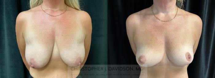 Breast Lift Case 436 Before & After Front | Boston, MA | Christopher J. Davidson, MD