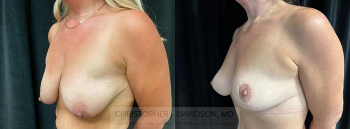 Breast Lift Case 436 Before & After Left Oblique | Boston, MA | Christopher J. Davidson, MD