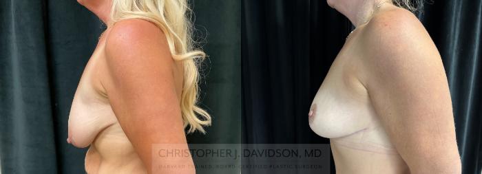 Breast Lift Case 436 Before & After Left Side | Boston, MA | Christopher J. Davidson, MD