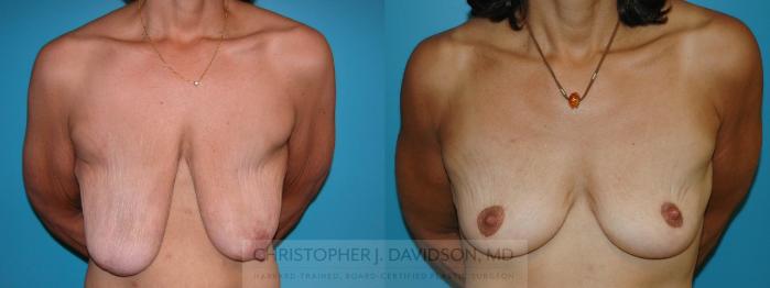 Breast Lift Case 6 Before & After View #1 | Wellesley, MA | Christopher J. Davidson, MD