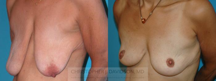 Breast Lift Case 6 Before & After View #2 | Wellesley, MA | Christopher J. Davidson, MD