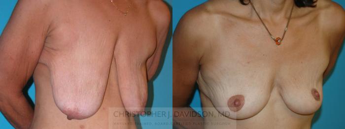 Breast Lift Case 6 Before & After View #3 | Wellesley, MA | Christopher J. Davidson, MD