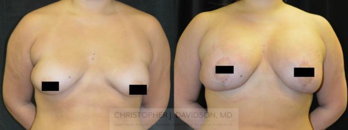 Breast Lift Case 78 Before & After View #1 | Boston, MA | Christopher J. Davidson, MD
