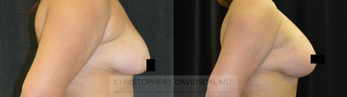 Breast Lift Case 78 Before & After View #2 | Boston, MA | Christopher J. Davidson, MD