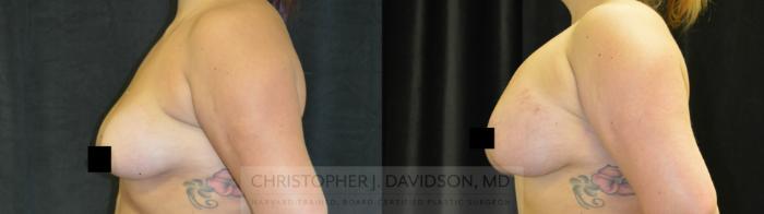 Breast Lift Case 78 Before & After View #3 | Boston, MA | Christopher J. Davidson, MD