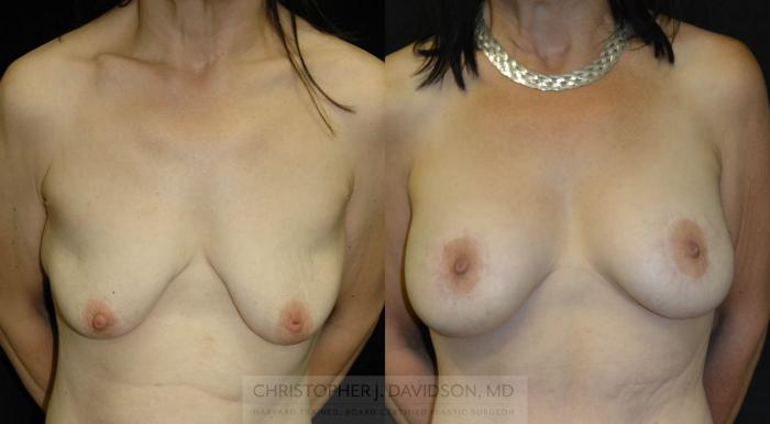 Breast Lift with Implants Case 15 Before & After View #1 | Boston, MA | Christopher J. Davidson, MD