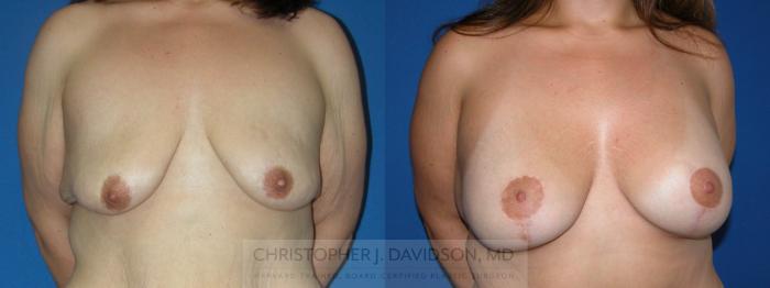 Breast Lift with Implants Case 187 Before & After View #1 | Boston, MA | Christopher J. Davidson, MD