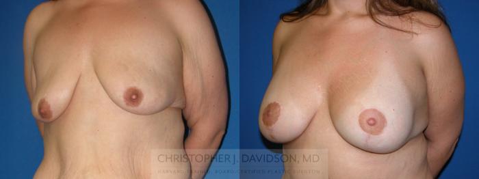 Breast Lift with Implants Case 187 Before & After View #2 | Boston, MA | Christopher J. Davidson, MD