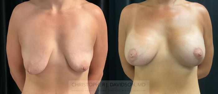 Breast Lift with Implants Case 274 Before & After Front | Boston, MA | Christopher J. Davidson, MD