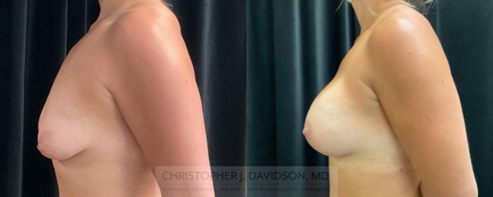 Breast Lift with Implants Case 274 Before & After Left Side | Boston, MA | Christopher J. Davidson, MD