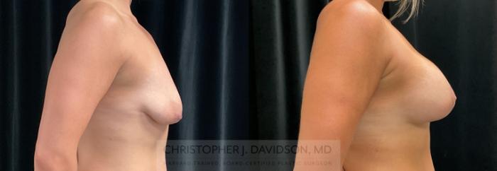 Breast Lift with Implants Case 274 Before & After Right Side | Boston, MA | Christopher J. Davidson, MD