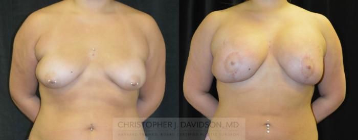 Breast Lift with Implants Case 334 Before & After Front | Boston, MA | Christopher J. Davidson, MD