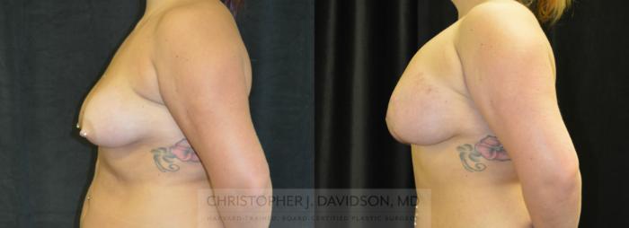 Breast Lift with Implants Case 334 Before & After Left Side | Boston, MA | Christopher J. Davidson, MD
