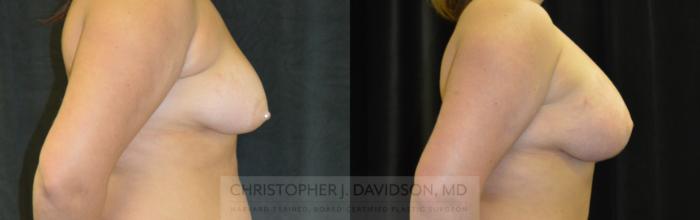 Breast Lift with Implants Case 334 Before & After Right Side | Boston, MA | Christopher J. Davidson, MD