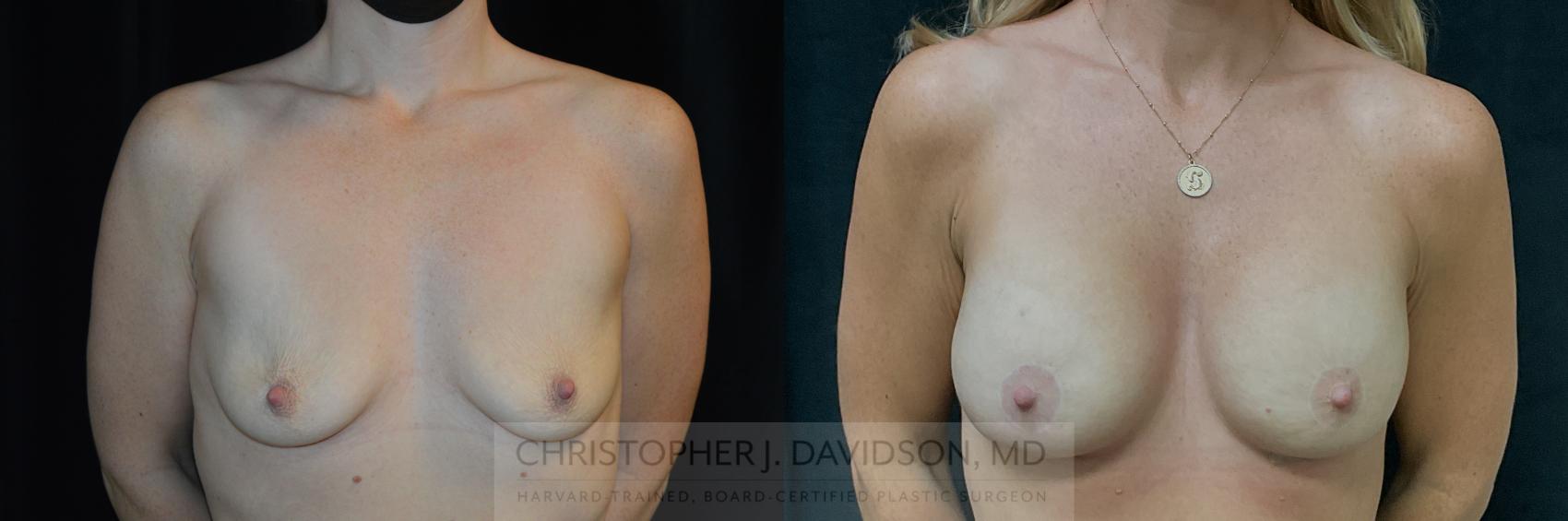 Breast Lift with Implants Case 347 Before & After Front | Boston, MA | Christopher J. Davidson, MD
