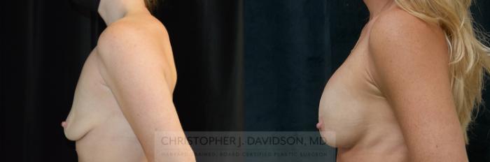 Breast Lift with Implants Case 347 Before & After Left Side | Boston, MA | Christopher J. Davidson, MD