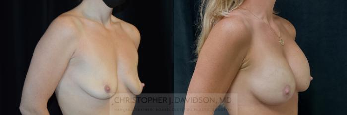 Breast Lift with Implants Case 347 Before & After Right Oblique | Boston, MA | Christopher J. Davidson, MD