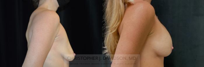 Breast Lift with Implants Case 347 Before & After Right Side | Boston, MA | Christopher J. Davidson, MD